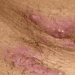Hidradenitis suppurativa associated with increased risk of subclinical atherosclerosis