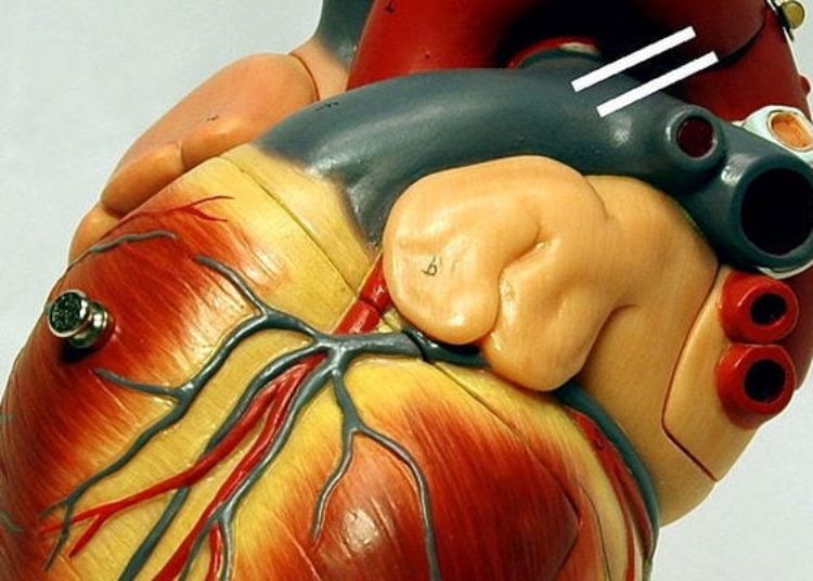 Long-term outcomes for off-pump and on-pump CABG are similar