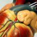Long-term outcomes for off-pump and on-pump CABG are similar
