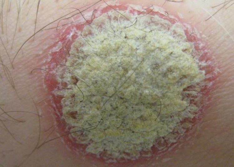 Patients with psoriasis associated with increased systemic arterial and subcutaneous adipose inflammation