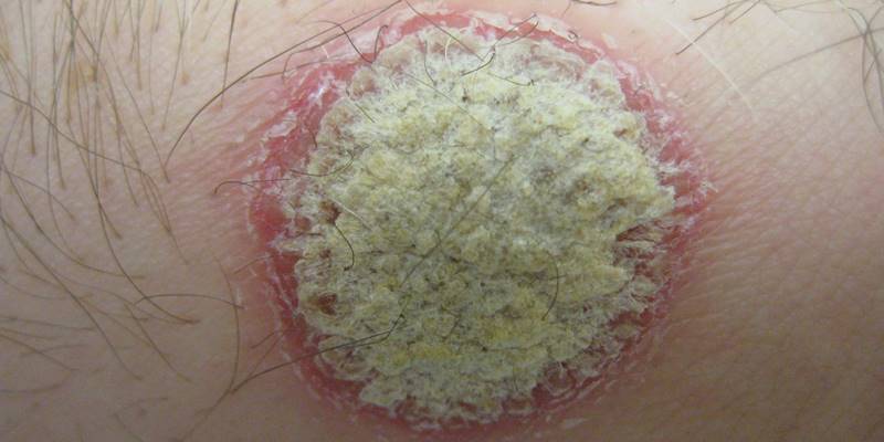 Psoriasis _cc_wiki_James Heilman, MD