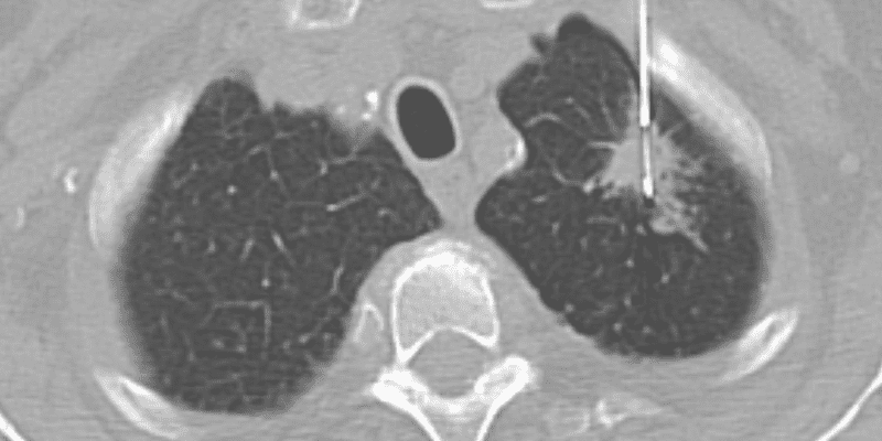 lung-cancer-ct