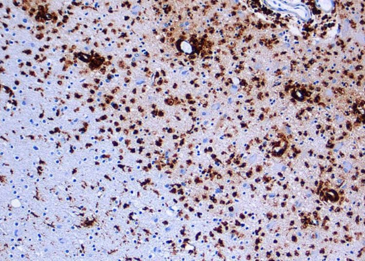 Asymptomatic women at high risk for Multiple Sclerosis may have early subclinical neuroimaging abnormalities