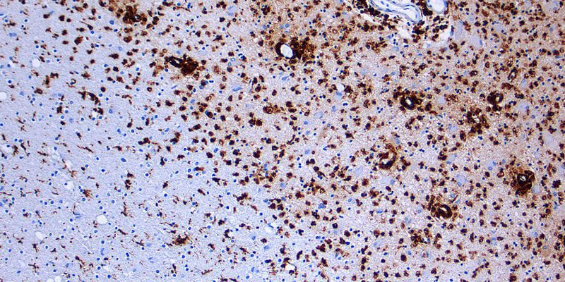 multiple-sclerosis