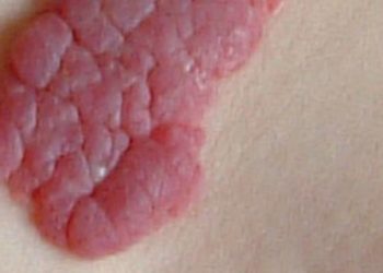 Laser therapy may be effective in patients with infantile hemangiomas