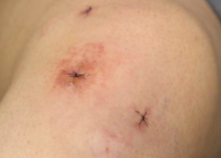 Prophylactic LMWH not associated with prevention of VTE after arthroscopy or casting: The POT-KAST and POT-CAST trials