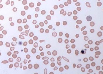 Crizanlizumab use lowers rates of sickle cell crises