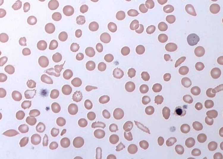 Crizanlizumab use lowers rates of sickle cell crises