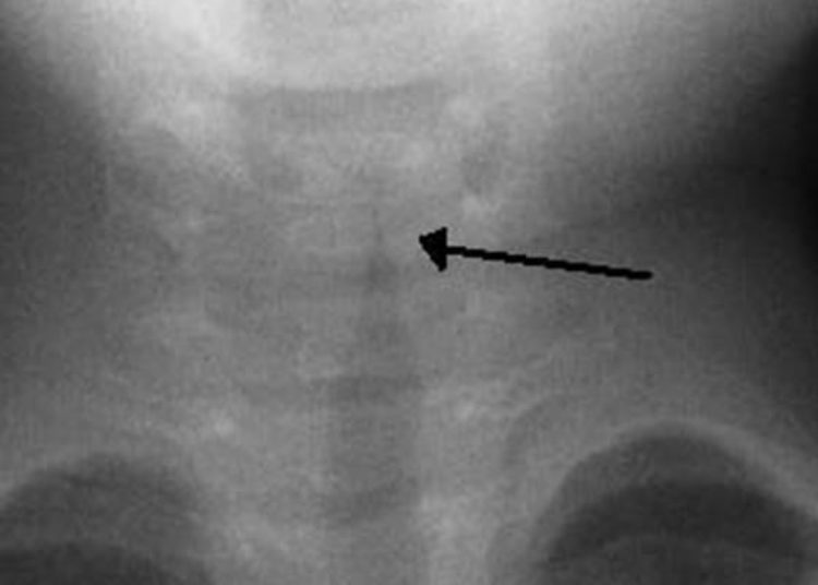 Inpatient management of croup varies widely by hospital