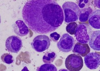 Imatinib safe and effective as long-term treatment for chronic myeloid leukemia: The IRIS trial