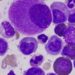 Imatinib safe and effective as long-term treatment for chronic myeloid leukemia: The IRIS trial