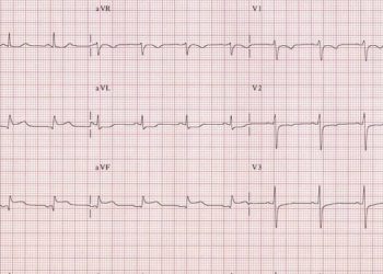 Using HEART score to risk stratify patients with chest pain is safe but underutilized in the ED