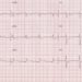 Using HEART score to risk stratify patients with chest pain is safe but underutilized in the ED