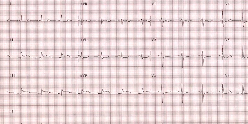 stemi-myocardial-infarct