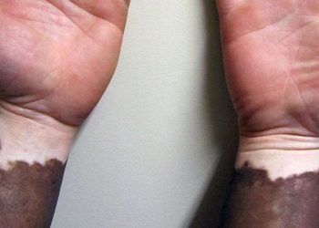 Long term phototherapy can enhance treatment response in vitiligo