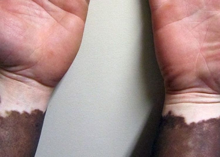 Long term phototherapy can enhance treatment response in vitiligo