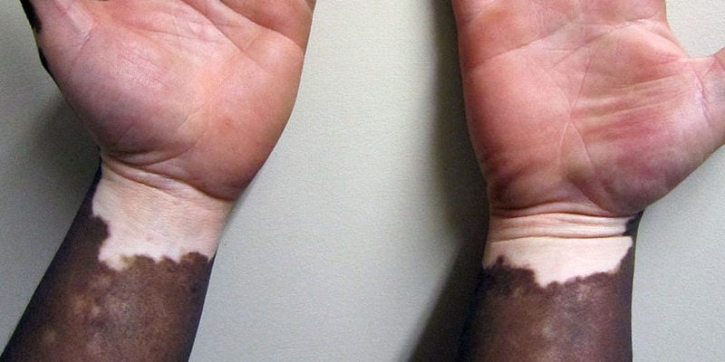 vitiligo