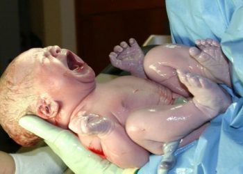 No link between cesarean delivery and BMI in later childhood
