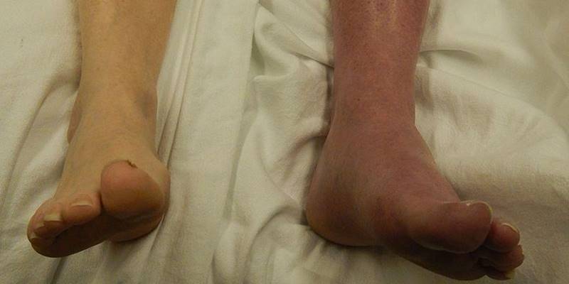 DVT2_cc_wiki_JamesHeilmanMD_edited
