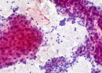 Prognostic indicators for transarterial chemoembolization in patients with hepatocellular carcinoma with extrahepatic spread identified