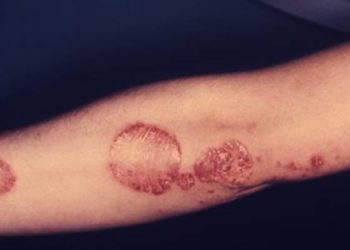 Long-term use of apremilast for psoriasis associated with an acceptable safety profile