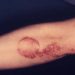Long-term use of apremilast for psoriasis associated with an acceptable safety profile