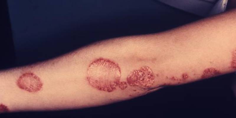 psoriasis PD