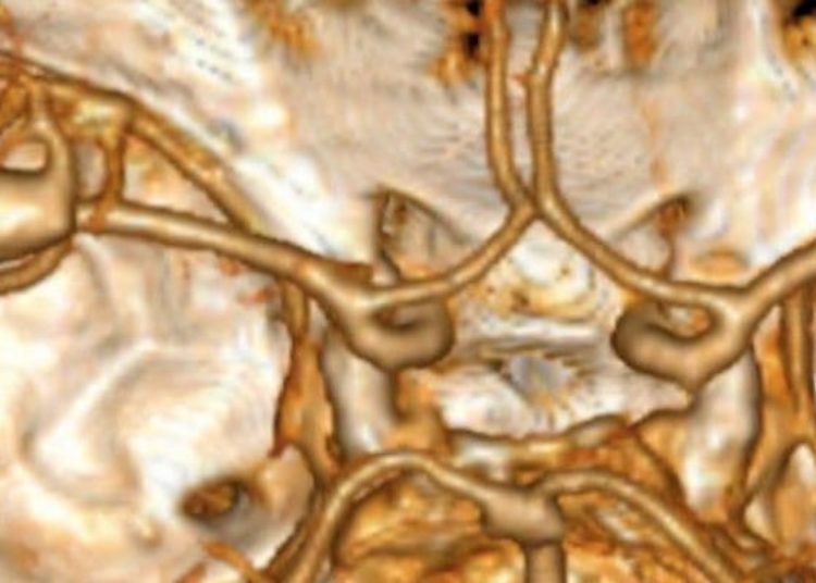 Small and very small unruptured intracranial aneurysms may have little risk for rupture