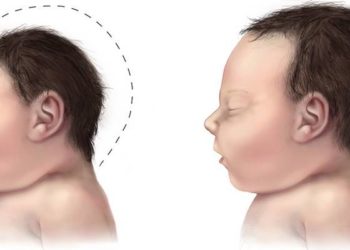 Microcephaly rates elevated in Brazil prior to Zika virus epidemic