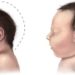 Microcephaly rates elevated in Brazil prior to Zika virus epidemic