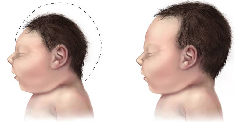 Microcephaly Rates Elevated In Brazil Prior To Zika Virus Epidemic 2 Minute Medicine
