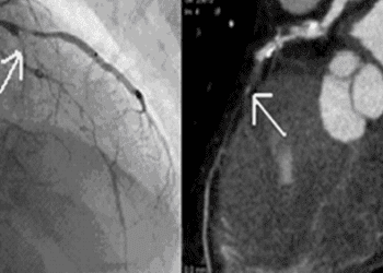 Physician visual assessment of coronary stenosis severity overestimates quantitative coronary angiography