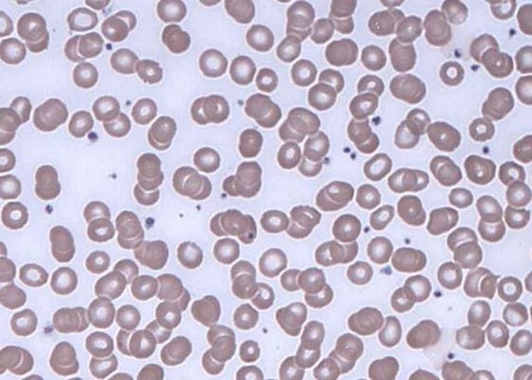 Shorter overall survival among patients with monoclonal gammopathy of undetermined significance