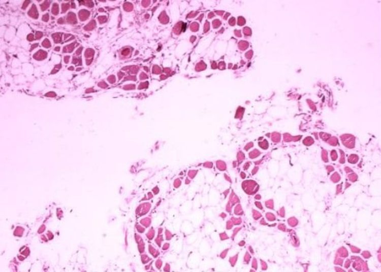 Gene therapy targets Duchenne muscular dystrophy in new trial [PreClinical]