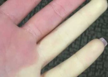 On-demand sildenafil (Viagra) shows limited effectiveness for Raynaud phenomenon