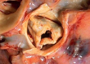 Aspirin alone likely safest antithrombotic therapy after bioprosthetic aortic valve replacement