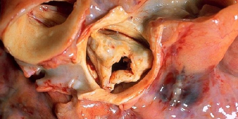 Aortic_stenosis_rotated