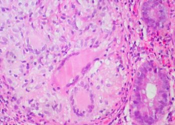Biosimilar to infliximab shows equivalent safety and efficacy for treating Crohn’s disease
