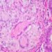Biosimilar to infliximab shows equivalent safety and efficacy for treating Crohn’s disease
