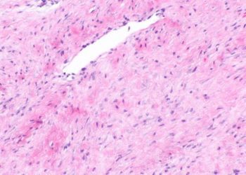 Sorafenib increases progression-free survival in patients with desmoid tumors