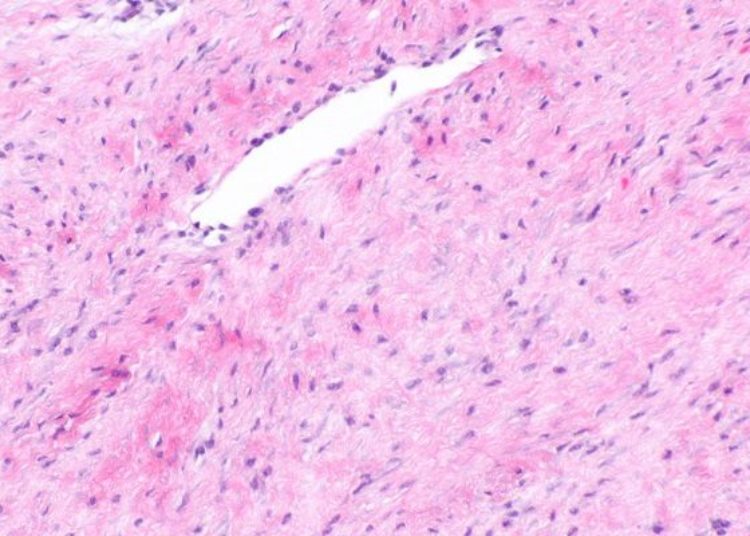 Sorafenib increases progression-free survival in patients with desmoid tumors