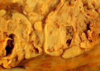 Quick Take: Influence of HIV Infection on the Natural History of Hepatocellular Carcinoma: Results From a Global Multicohort Study