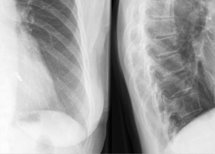 MitraClip does not significantly improve outcomes in secondary mitral regurgitation: the MITRA-FR trial