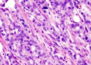 Modified FOLFIRINOX results in longer disease-free survival in metastatic pancreatic cancer patients compared to gemcitabine