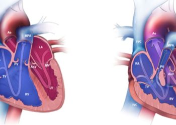 Quick Take: Long-term Outcomes of Tetralogy of Fallot: A Study From the Pediatric Cardiac Care Consortium