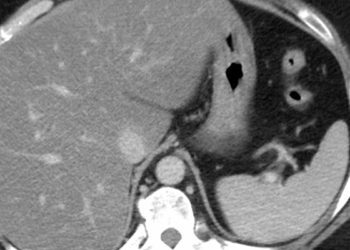 Low free sugar diet reduces hepatic steatosis in nonalcoholic fatty liver disease in adolescent males