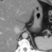 Low free sugar diet reduces hepatic steatosis in nonalcoholic fatty liver disease in adolescent males