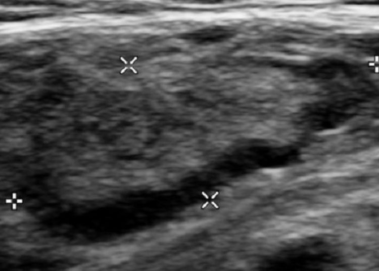 Quick Take: Use of Hormone Replacement Therapy and Risk of Venous Thromboembolism: Nested Case-Control Studies Using the QResearch and CPRD Databases