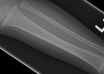 Quick Take: Effect of intranasal ketamine vs. fentanyl on pain reduction for extremity injuries in children: the PRIME randomized clinical trial