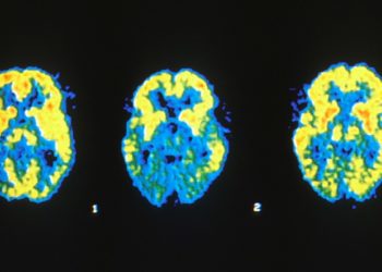 Intensive blood pressure control may decrease risk of mild cognitive impairment